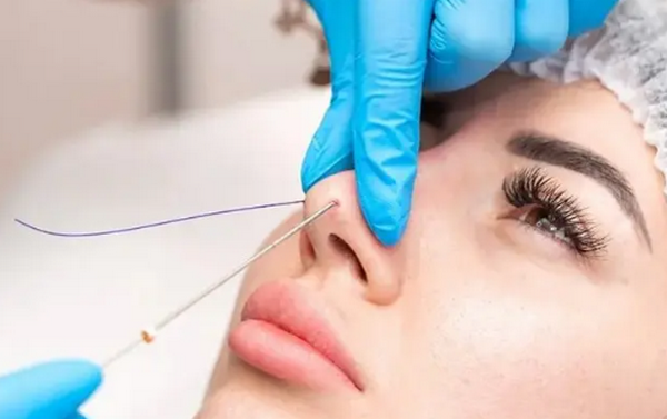 Thu gọn cánh mũi với phương pháp KHÔNG PHẪU THUẬT