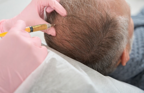 Quý ông nhận trái đắng khi đi cấy tóc chữa hói đầu