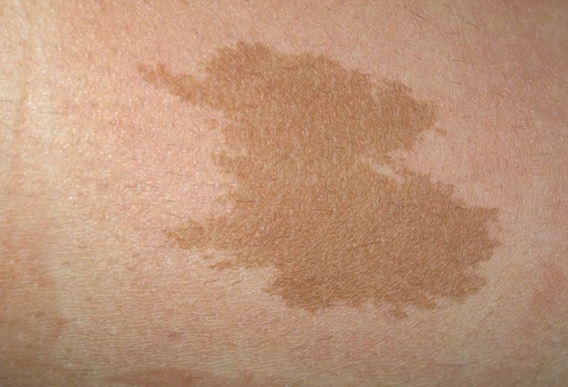 Bớt sắc tố da là gì? Nguyên nhân, dấu hiệu và cách điều trị hiệu quả