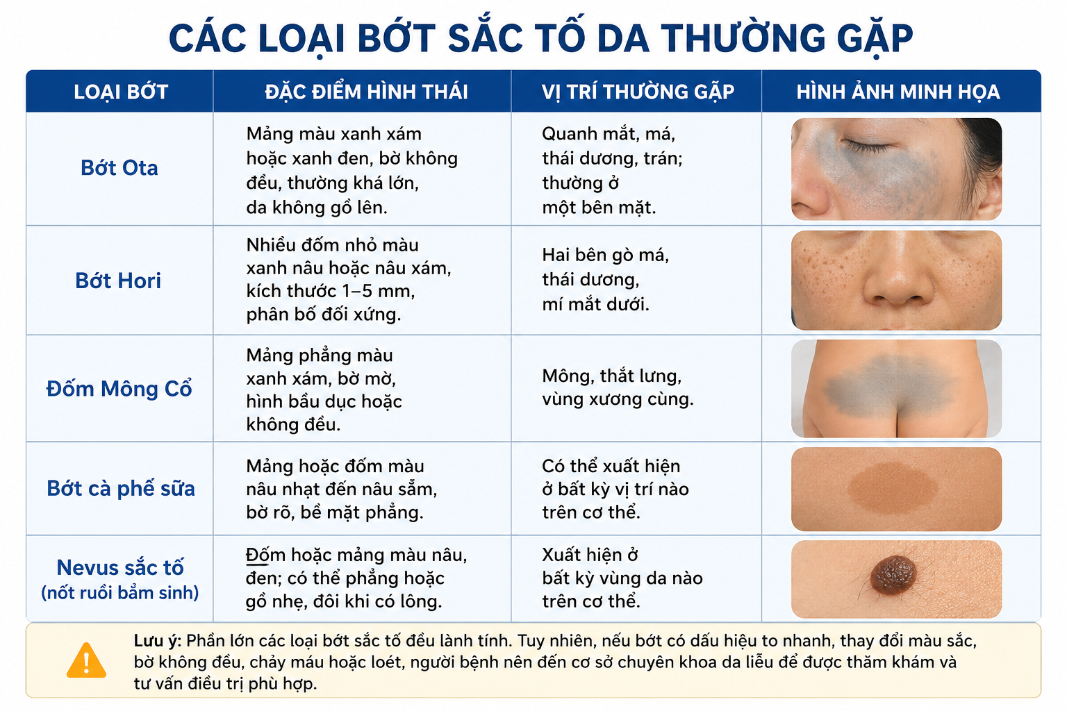 Bớt sắc tố da là gì? Nguyên nhân, dấu hiệu và cách điều trị hiệu quả 