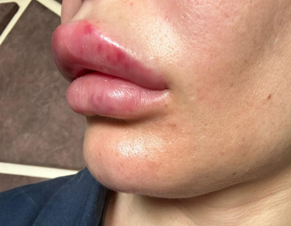 Tiêm filler bị sưng lâu không, khi nào cần nhập viện theo dõi