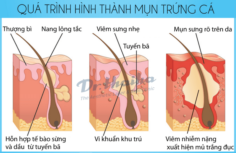 Mụn trứng cá có mủ: Nguyên nhân và cách điều trị an toàn hiệu quả