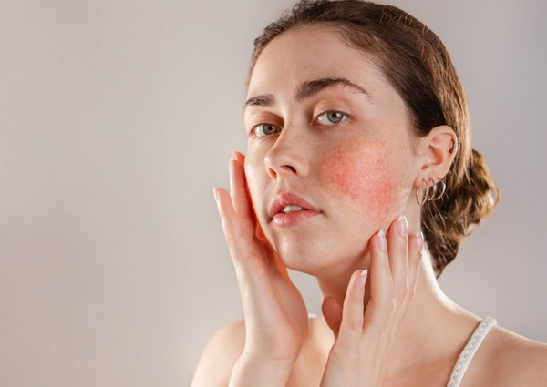 Da mặt nổi mẩn đỏ và ngứa là bị làm sao? Có nguy hiểm không