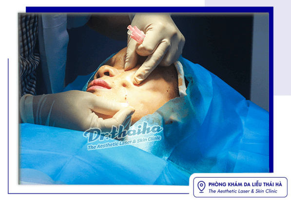 Căng chỉ sau bao nhiêu lâu thì đẹp, cần kiêng những gì?