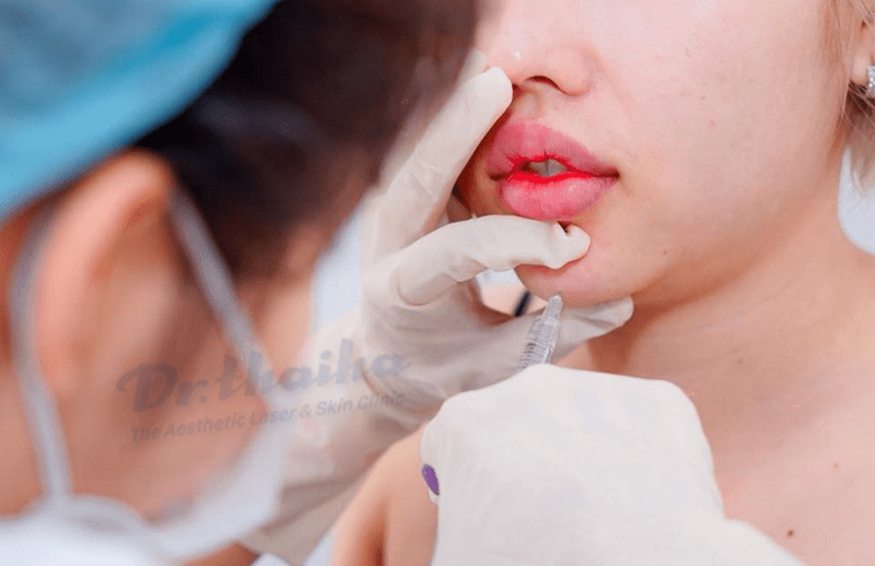 Tiêm filler vào môi có gây đau không và liệu có cần sử dụng gì để giảm đau trong quá trình tiêm?
