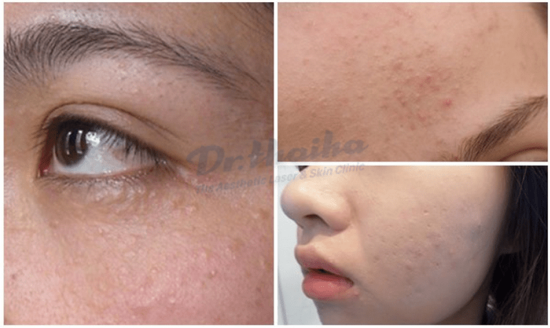 Hiệu quả của phương pháp peel da trị mụn ẩn đối với làn da bạn
