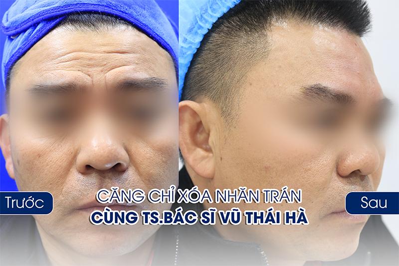 Cách điều trị và xóa nếp nhăn trên trán an toàn hiệu quả