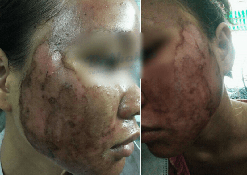 Thay da sinh học có nguy hiểm không?