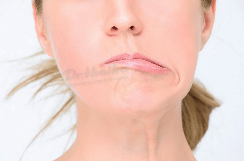 Tiêm botox nhiều liệu có gây méo miệng, xếch mắt hay rối loạn cơ mặt không? 
