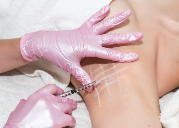 Tiêm botox trị hôi nách có thực sự tốt không? giá bao nhiêu tiền?