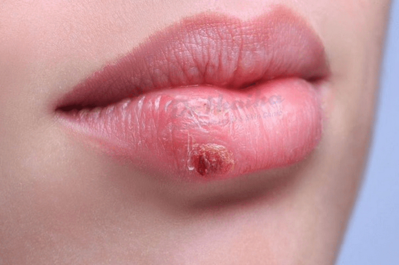 Cách điều trị hiệu quả khi tiêm filler môi bị nổi mụn nước 