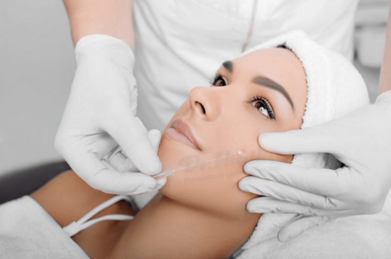 Có nên căng chỉ collagen không? Chuyên gia hàng đầu chia sẻ