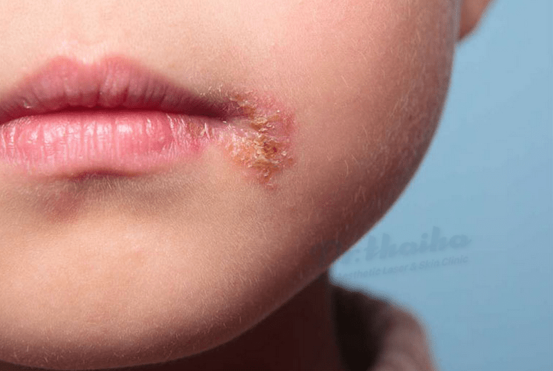 Virus Herpes simplex (HSV) là nguyên nhân gây ra bệnh rộp môi như thế nào?

