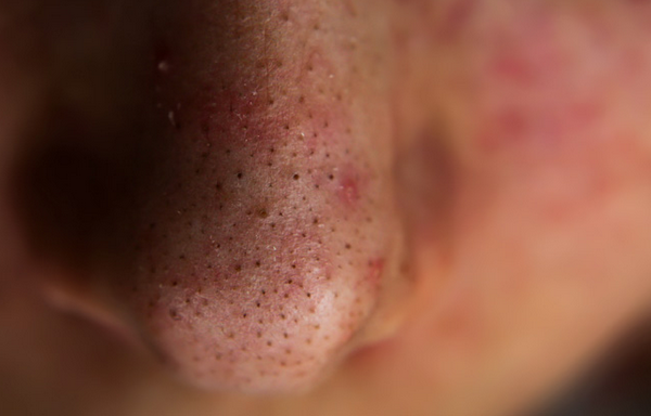 Sợi bã nhờn là gì? Có phải mụn đầu đen không? Cách kiểm soát hiệu quả