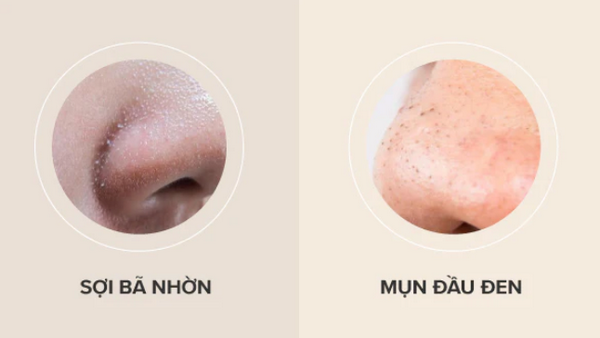 Sợi bã nhờn là gì? Có phải mụn đầu đen không? Cách kiểm soát hiệu quả