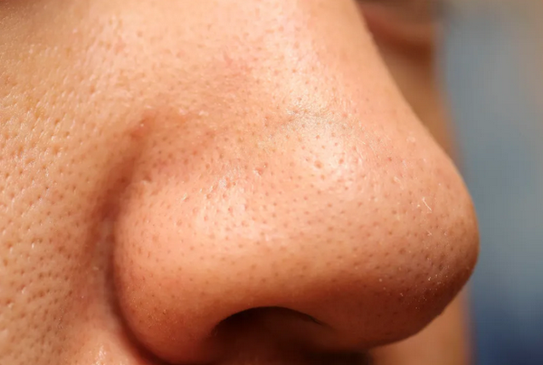 Sợi bã nhờn là gì? Có phải mụn đầu đen không? Cách kiểm soát hiệu quả