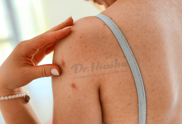 Peel da trị mụn lưng bao nhiêu tiền, cần lưu ý những gì? | Dr.thaiha