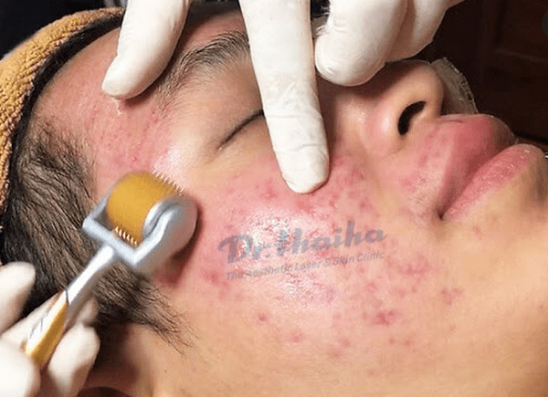 Hậu quả của lăn kim trị mụn bằng rượu thuốc, chuyên gia cảnh báo