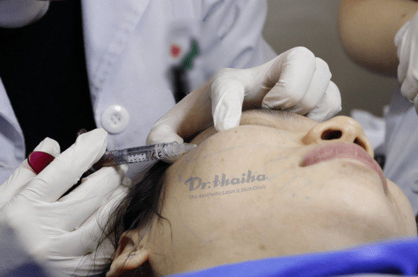 Tiêm filler giữ được bao lâu, có nên tiêm nhiều lần không