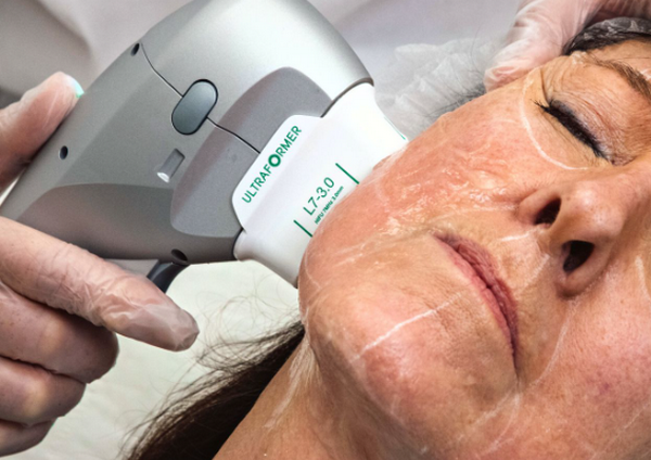 Căng da mặt hifu và những điều bạn cần nên biết