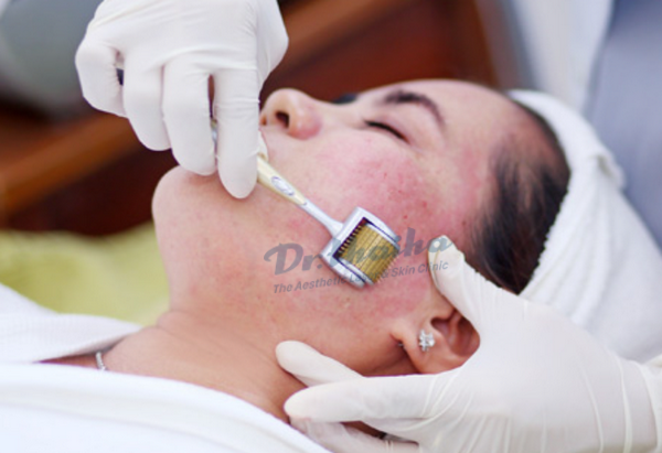 Đừng nên lăn kim tại Spa nếu bạn vẫn chưa đọc bài chia sẻ này