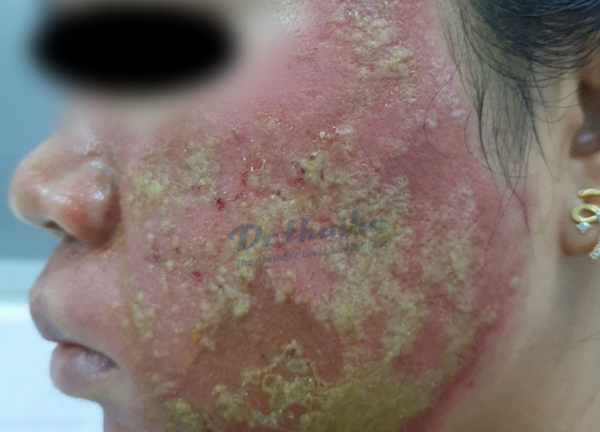 Đừng nên lăn kim tại Spa nếu bạn vẫn chưa đọc bài chia sẻ này