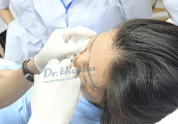 Filler tạm thời là gì? Các loại filler được sử dụng trong thẩm mỹ