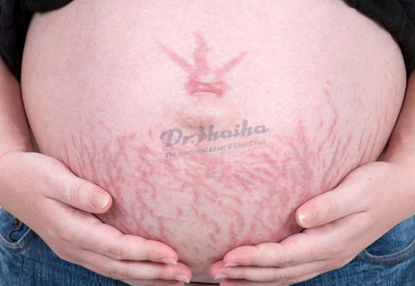 Bí quyết chống rạn da bụng khi mang thai siêu hiệu quả