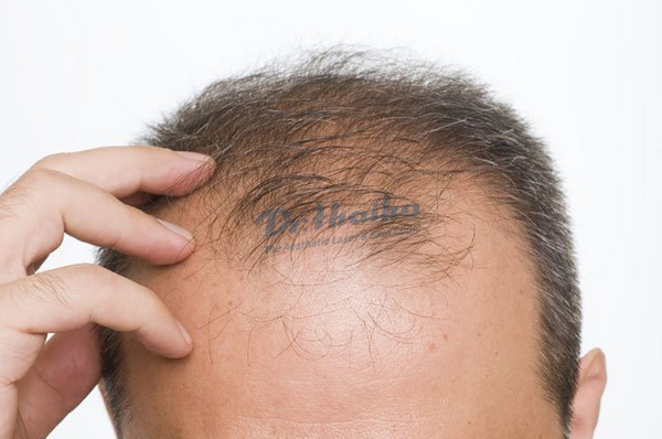 Rụng tóc không sẹo là bệnh gì?
