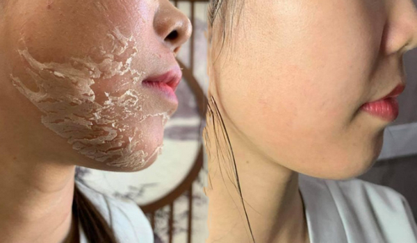 Bật mí cùng bạn sản phẩm peel da tốt nhất trên thị trường