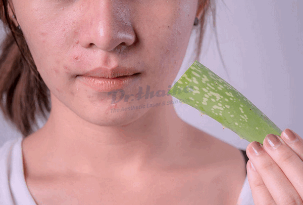 Cách trị mụn trứng cá bọc nhanh nhất hiệu quả nhất