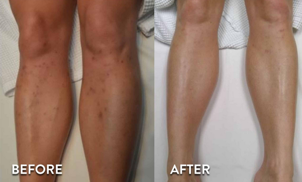 Hỏi đáp: Triệt lông laser mấy buổi sẽ hết, lông có mọc lại không?