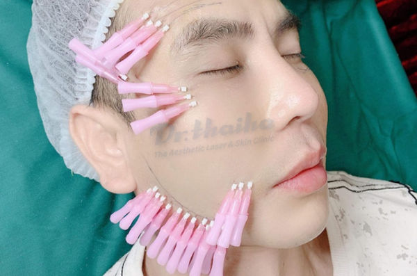 Căng da mặt bằng chỉ collagen duy trì được bao lâu