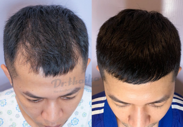 6 bí quyết chữa trị rụng tóc ở nam giới  ELLE Man
