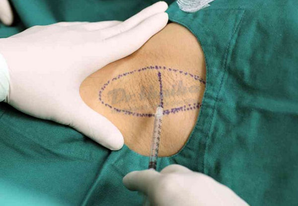 Cách trị mồ hôi nách vĩnh viễn tại nhà và một số lưu ý