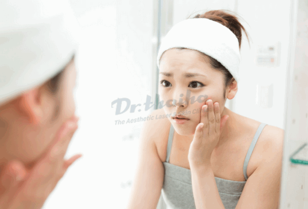 Mụn trứng cá 2 bên thái dương và cách chữa trị