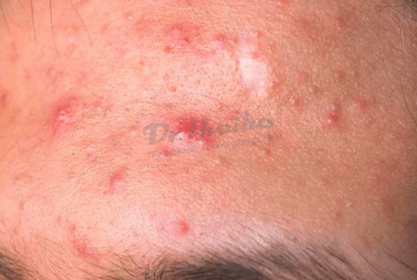 Mụn trứng cá ở trán: Nguyên nhân và phương pháp chữa trị an toàn