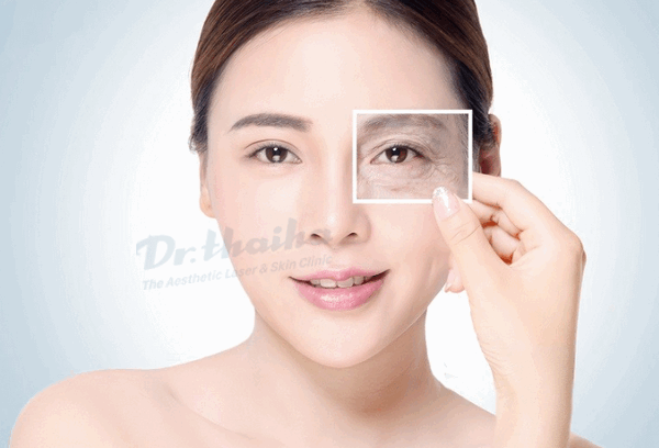 Căng da vùng mắt không phẫu thuật và những điều cần biết