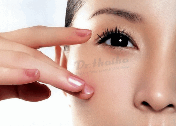 Căng da vùng mắt không phẫu thuật và những điều cần biết