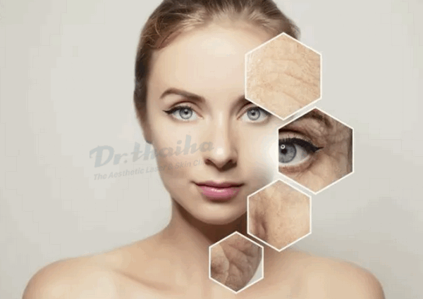 Căng da vùng mắt không phẫu thuật và những điều cần biết