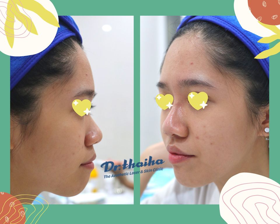 Cấy chỉ collagen là gì? Một số hình ảnh làm đẹp công nghệ này