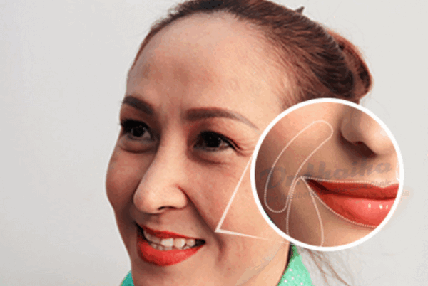 Tiêm botox rãnh cười là gì?