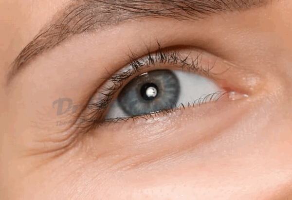 Vết nhăn mắt: Nguyên nhân và cách xử lý hiệu quả