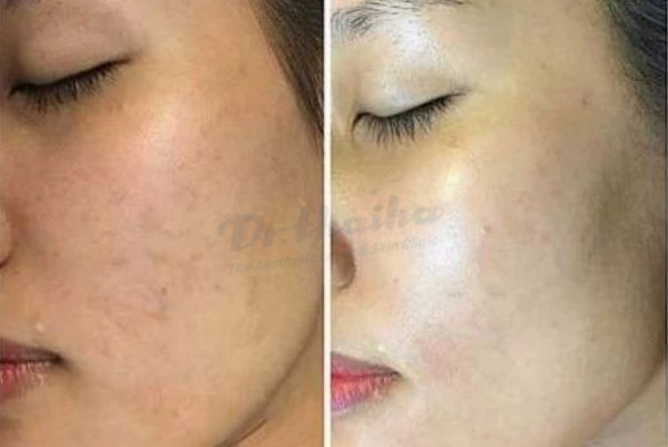 Điều trị tàn nhang chi phí hết bao nhiêu? Bảng giá mới nhất