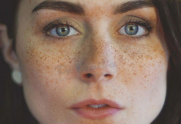 Điều trị tàn nhang chi phí hết bao nhiêu? Bảng giá mới nhất