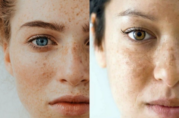 Cách trị nám tàn nhang bằng thảo dược và một số lưu ý