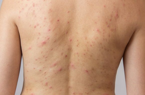 Mụn trứng cá cơ học (Acne Mechanica): Dấu hiệu, nguyên nhân và cách chữa