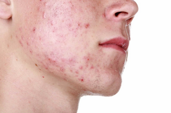Mụn trứng cá cơ học (Acne Mechanica): Dấu hiệu, nguyên nhân và cách chữa