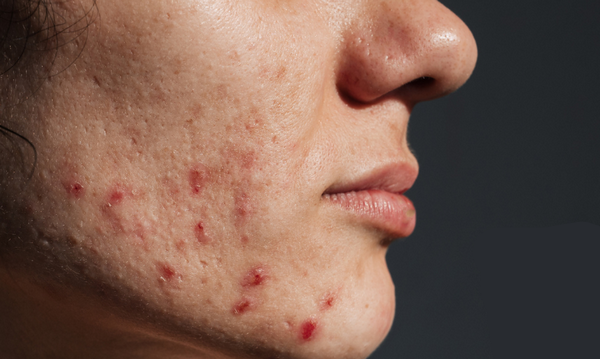 Mụn trứng cá cơ học (Acne Mechanica): Dấu hiệu, nguyên nhân và cách chữa