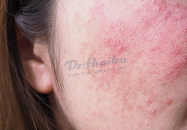 Lột da mặt bị đỏ và rát là bị làm sao? Cách khắc phục